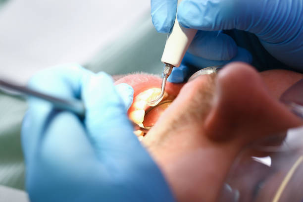 Best Emergency Wisdom Teeth Removal in Shenandoah, LA